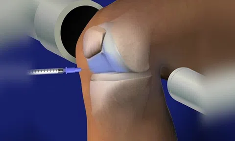 Tiêm chất nhờn khớp gối: Giải pháp điều trị tổn thương khớp an toàn, hiệu quả