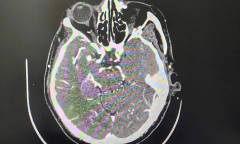 Đột quỵ khi uống bia, người đàn ông thoát chết ngoạn mục